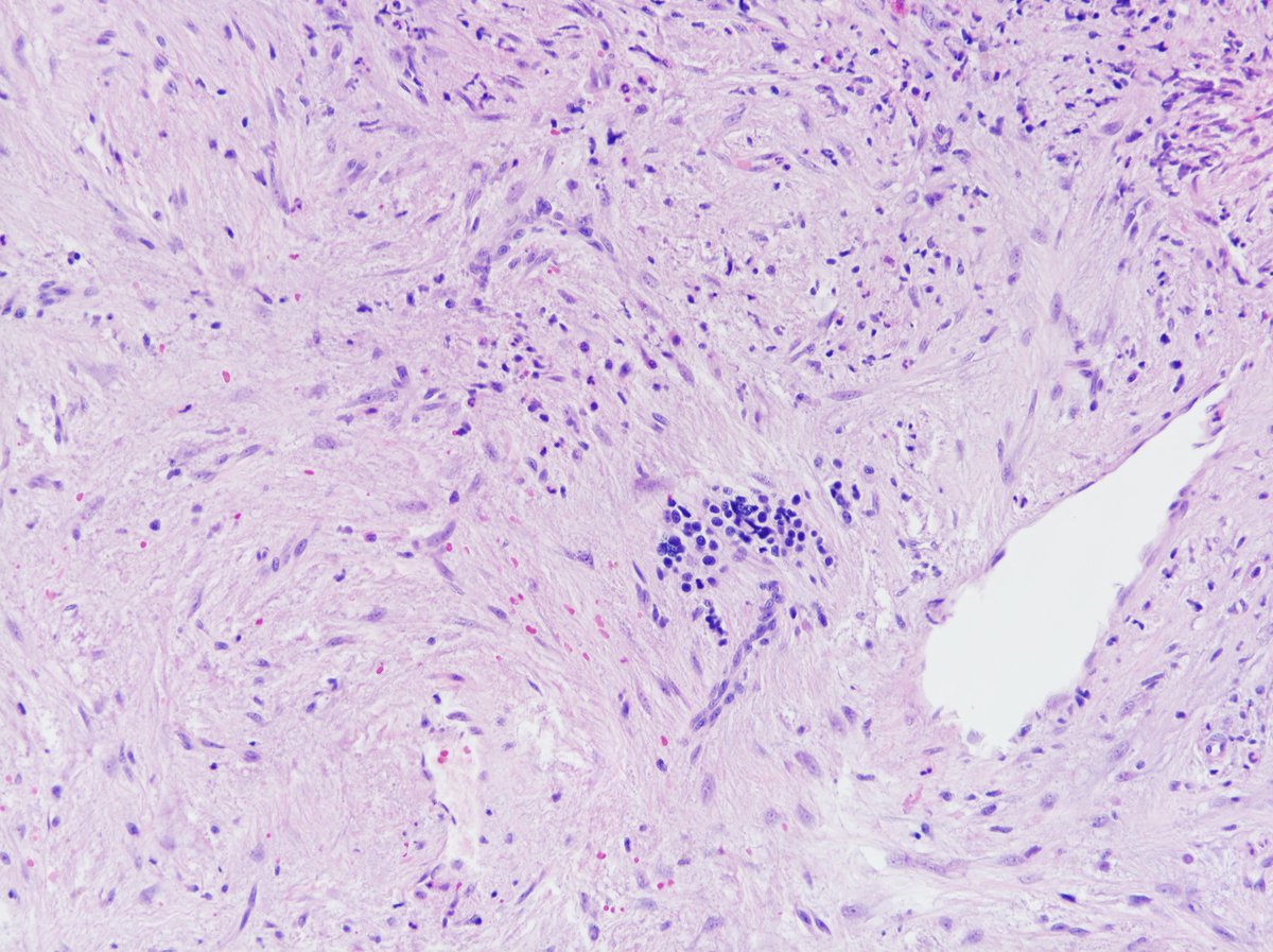 Higher magnification showing  focal residual  erythropoiesis